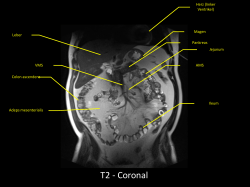 T2 - Coronal