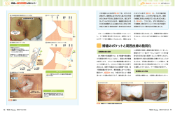 褥瘡のポケットと周囲皮膚の脆弱化