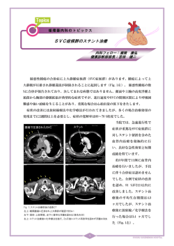 SVC症候群のステント治療(2012年5月)