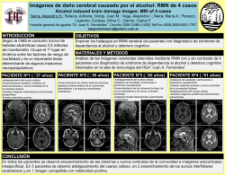 Im&aacute;genes de da&ntilde;o cerebral causado por el alcohol
