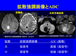 拡散強調画像とADC - 脳梗塞とMRIのページ