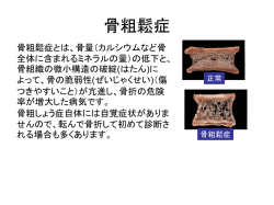 腰部疾患の運動指導