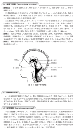 穿刺法 1 患者を側臥位とし頸部を正しく正中位に保ち，頭部を軽く前屈し