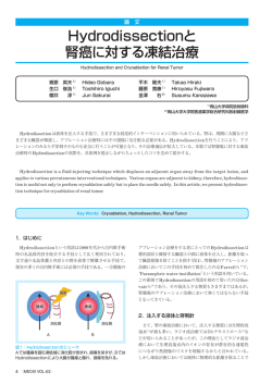 Hydrodissectionと 腎癌に対する凍結治療