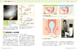 排便姿勢といきみ指導
